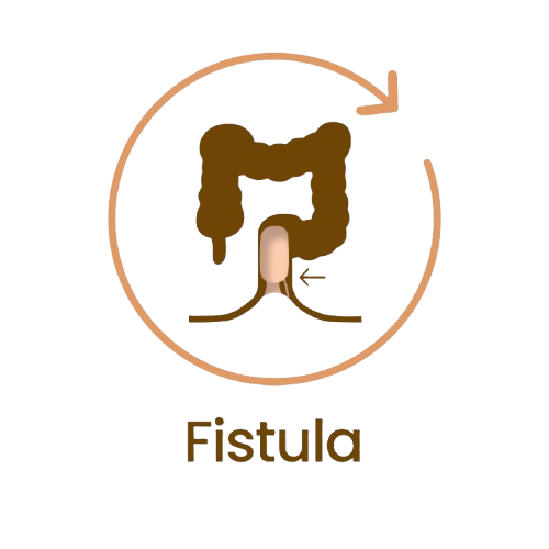 Fistula-2-removebg-preview